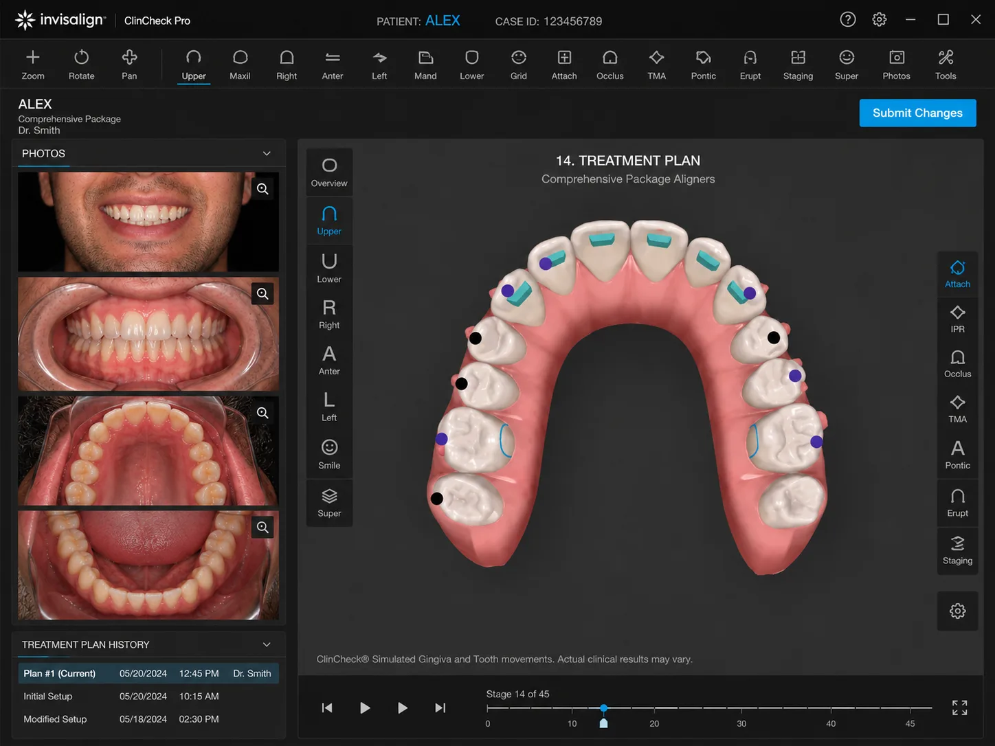 Simulare digitală 3D ClinCheck a tratamentului Invisalign la DentalMed Brașov