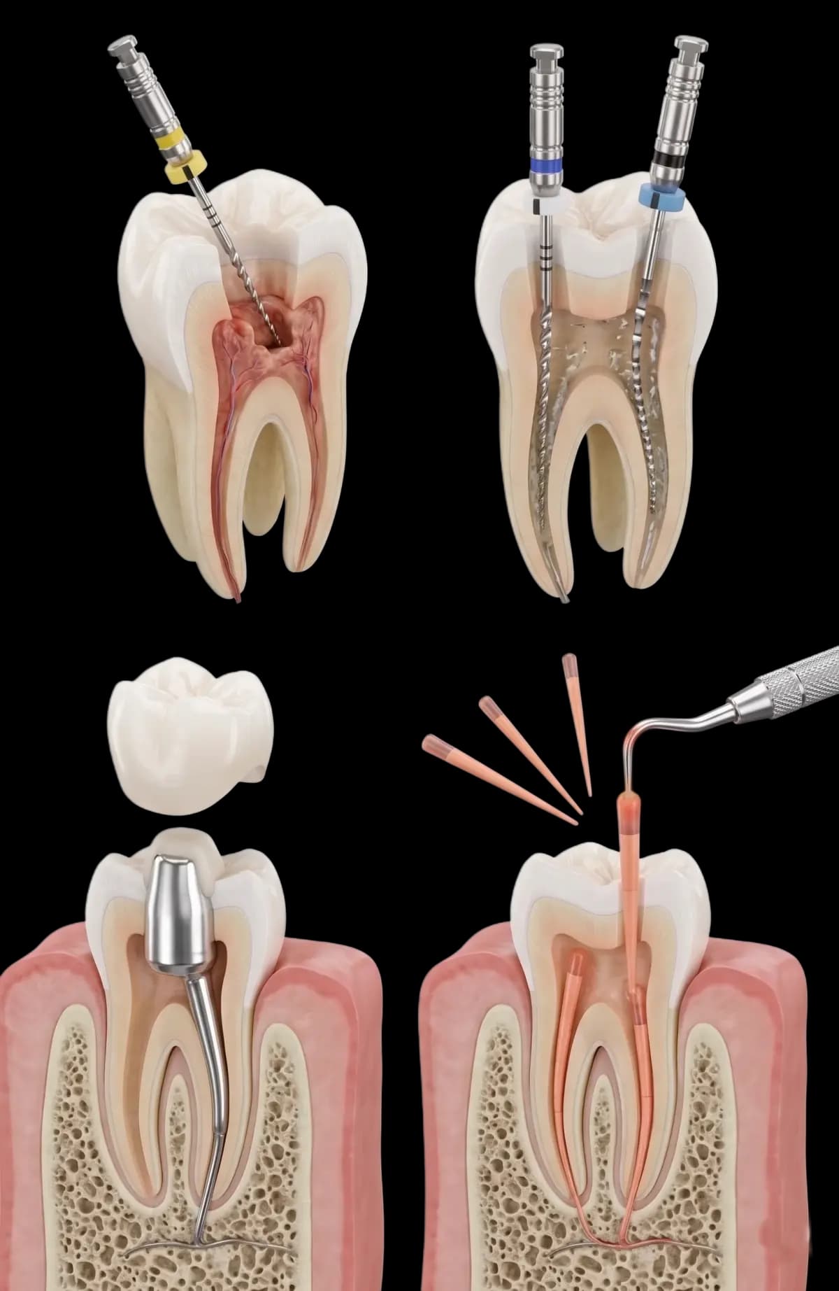 Etapele tratamentului