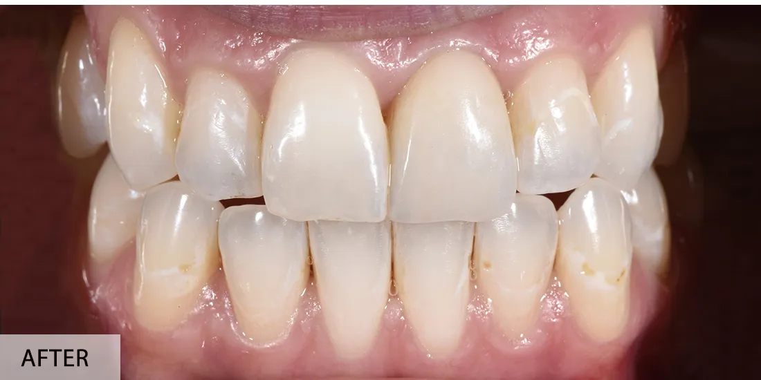 Mihai Popescu — după implant simplu