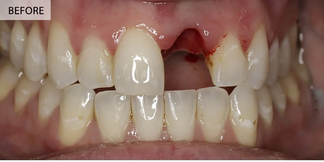 Mihai Popescu — înainte de implant simplu