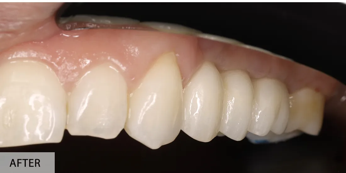 Elena Ionescu — după implant simplu