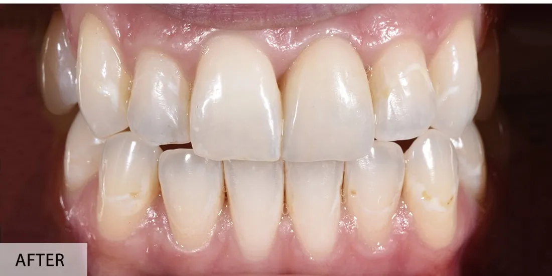 Dan Vlad — după implant simplu